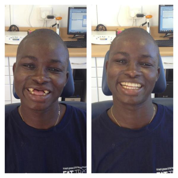 Luke before and after his dental surgery. 